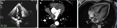 Case report: Left atrial myxoma with morphology of cavernous hemangioma supplied by the right coronary artery